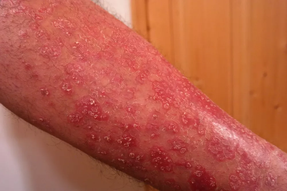 psoriasis-gc3a0b601e_1920